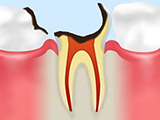 C4【歯根まで達した虫歯】