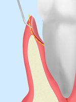 歯周ポケット掻爬術